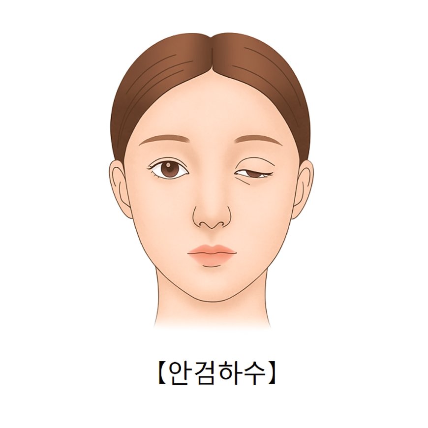 Зовхи унжилт өөрөө оношлох арга ба байгалийн наалдамхай нүдний засал | Нойрмог харагдах нүдийг сайжруулах