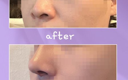 "Wonderful"  Гоо сайхны мэс заслын эмнэлэг  Before & After  Хамрын мэс засал