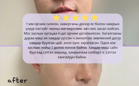 "Wonderful"  Гоо сайхны мэс заслын эмнэлэг  Before & After  Хамрын мэс засал