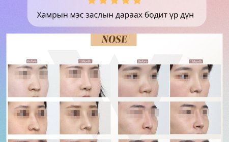 "Wonderful"  Гоо сайхны мэс заслын эмнэлэг  Before & After  Хамрын мэс засал