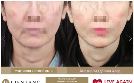 Before & After  LIENJANG plastic surgery