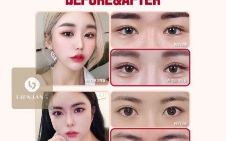 "Lienjang гоо сайхны мэс заслын эмнэлэг"  Давхрааны давтан мэс засал