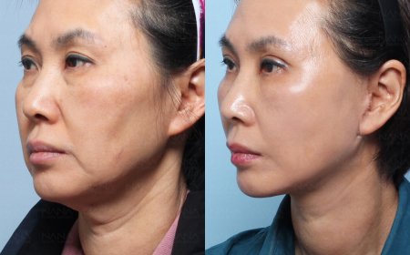 NANA plastic surgery🇰🇷 залуужуулах мэс заслын дараах өөрчлөлт