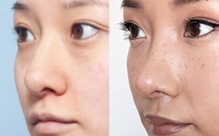 NANA Plastic surgery Хамрын мэс засал