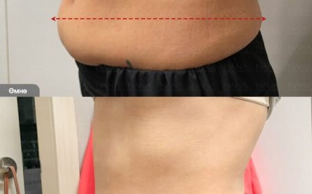 Хэвлийн өөх соруулах мэс засал