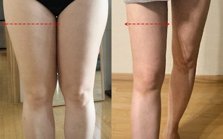 NANA Гуяны өөх соруулах мэс засал