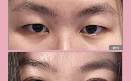 NANA Нүдний мэс засал  Before & After  Солонгосын Гангнам дүүрэгт байрлалтай NANA гоо сайхны эмнэлэг