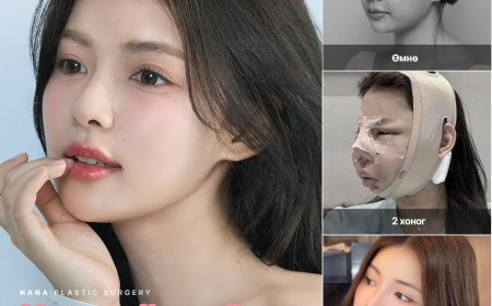 Нүүрний хэлбэр засах гурвалсан мэс засал