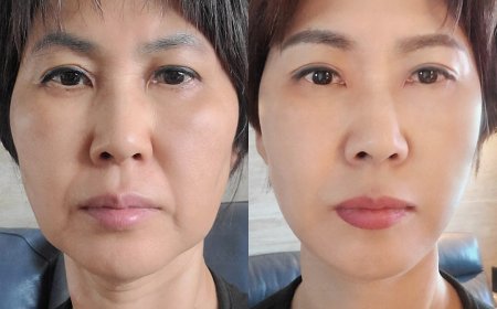 NANA залуужуулах мэс заслын дараах өөрчлөлт