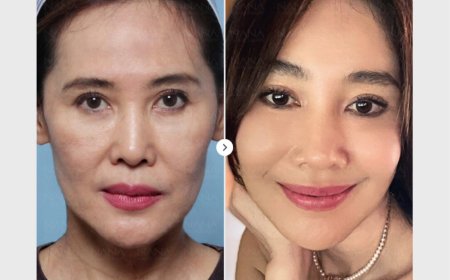 NANA Гоо сайхны эмнэлэгт “Залуужуулах мэс засал”-д орсон үйлчлүүлэгчийн өөрчлөлт