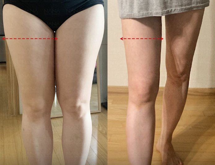 NANA Гуяны өөх соруулах мэс засал