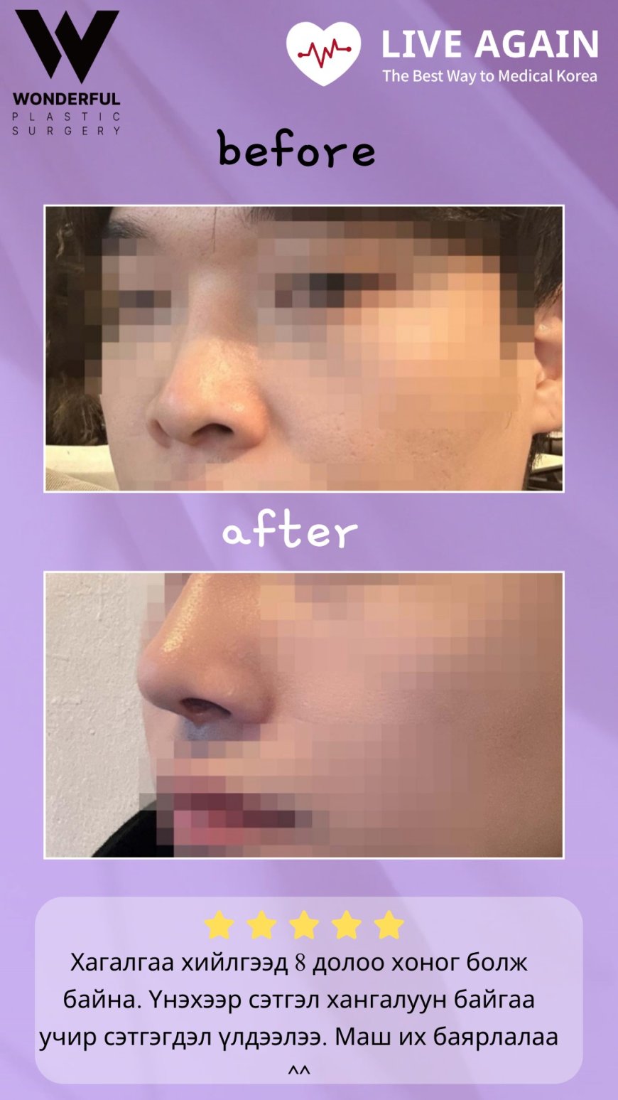 "Wonderful"  Гоо сайхны мэс заслын эмнэлэг  Before & After  Хамрын мэс засал