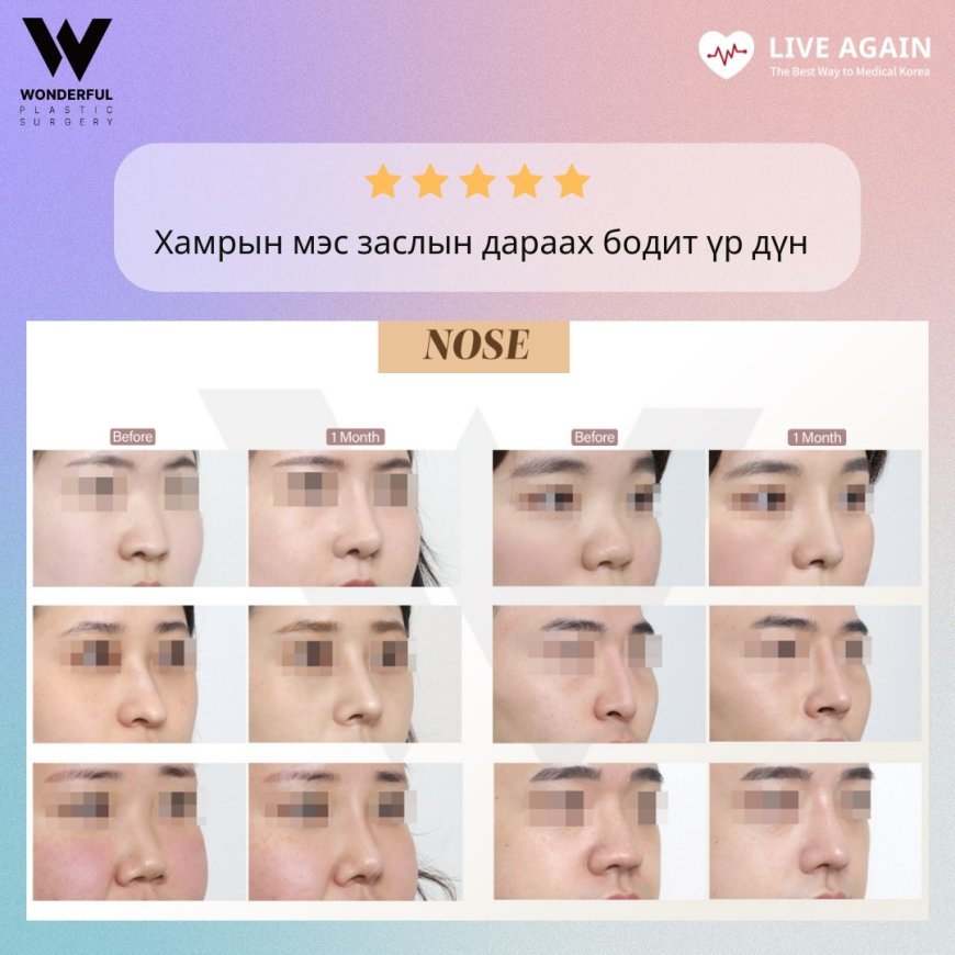 "Wonderful"  Гоо сайхны мэс заслын эмнэлэг  Before & After  Хамрын мэс засал