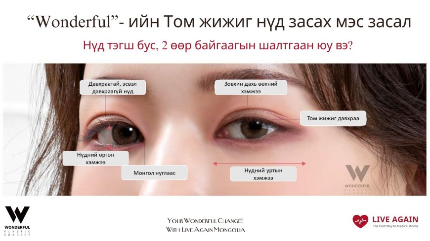 " Том жижиг нүд засах хагалгаа "  Wonderful Plastic Surgery