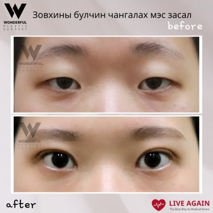 Зовхины булчин чангалах мэс засал