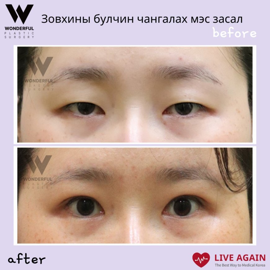 Зовхины булчин чангалах мэс засал