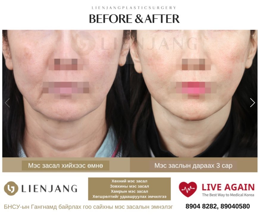 Before & After  LIENJANG plastic surgery