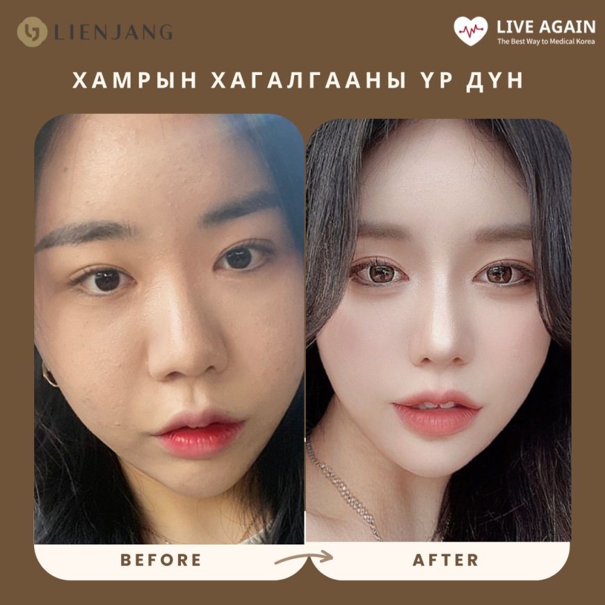 Хамрын мэс засал  Before & After