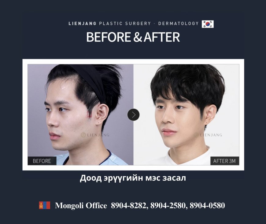 Before & After Доод эрүүний мэс засал
