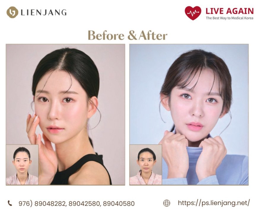 "Lienjang гоо сайхны мэс заслын эмнэлэг" Before & After 