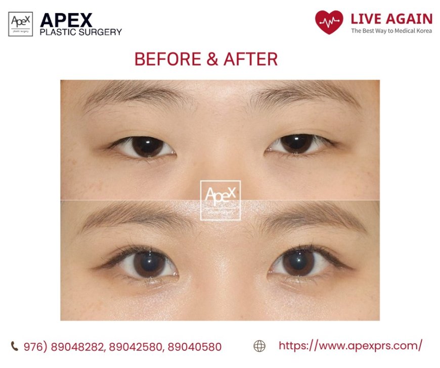 " Apex " Гоо сайхны мэс заслын эмнэлэг  Before & After 