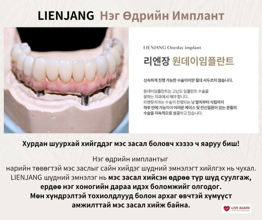 Нэг өдрийн имплант  "Lienjang шүдний эмнэлэг"
