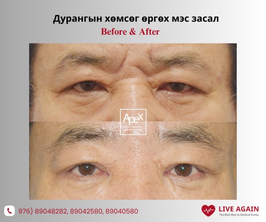 Дурангаар Хөмсөг өргөх мэс засал