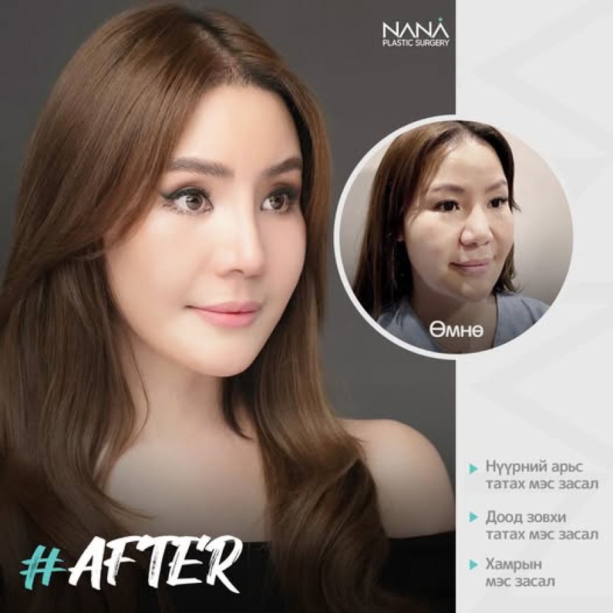 "Нана гоо сайхны мэс заслын эмнэлэг"   Before & After 