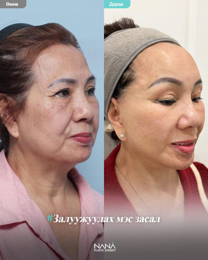 Солонгосын NANA гоо сайхны эмнэлэг [NANA залуужуулах мэс заслын дараах өөрчлөлт]