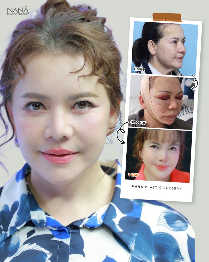 NANA залуужуулах мэс заслын дараах өөрчлөлт