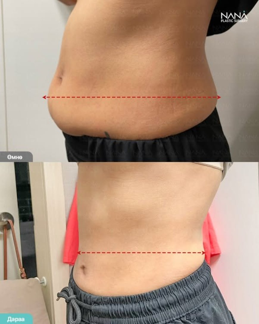 Хэвлийн өөх соруулах мэс засал