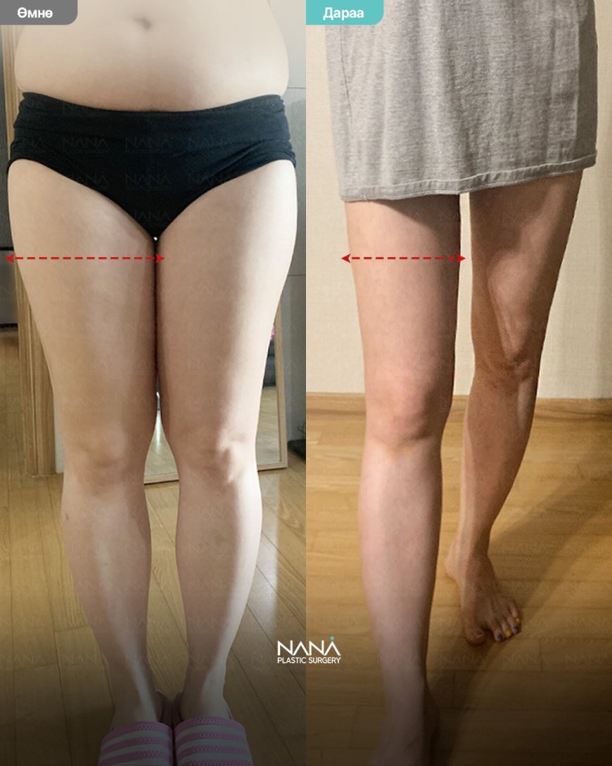 NANA Гуяны өөх соруулах мэс засал