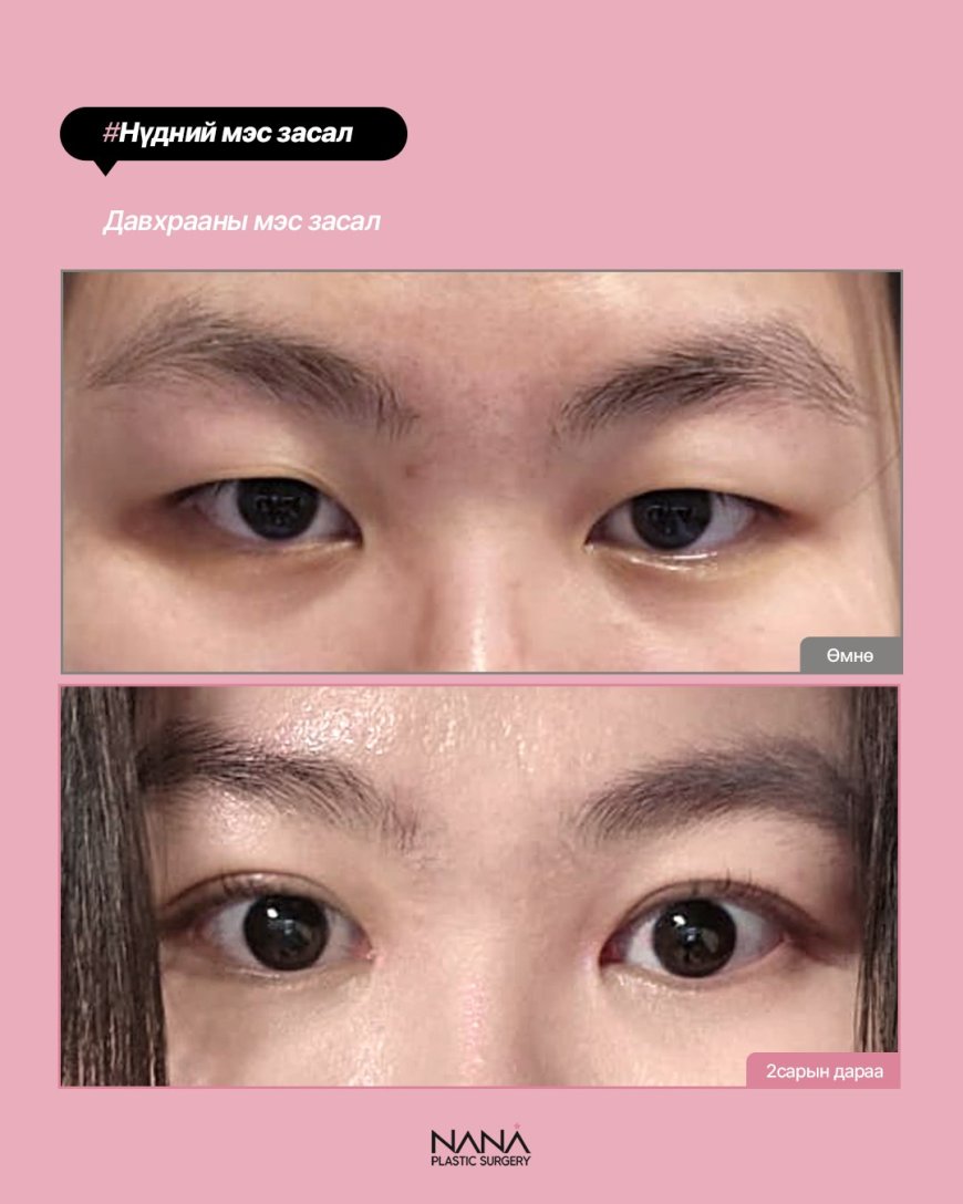 NANA Нүдний мэс засал  Before & After  Солонгосын Гангнам дүүрэгт байрлалтай NANA гоо сайхны эмнэлэг