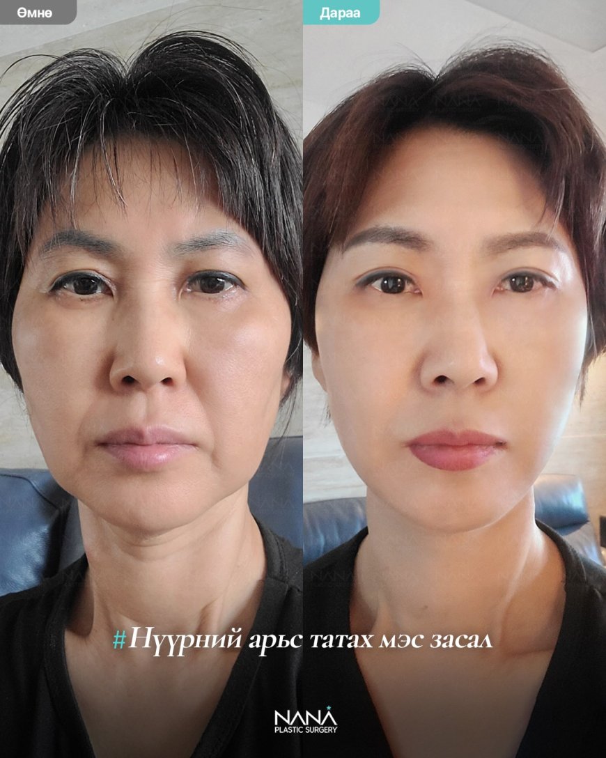 NANA залуужуулах мэс заслын дараах өөрчлөлт