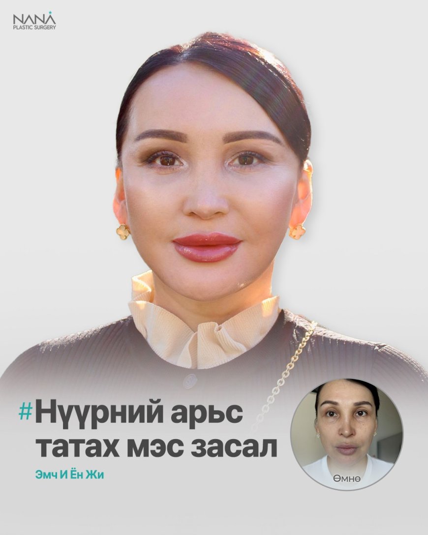 NANA Арьс татах мэс засал, Дээд, доод зовхи татах мэс засал, Нүүрэнд өөх суулгах мэс заслын дараах өөрчлөлт