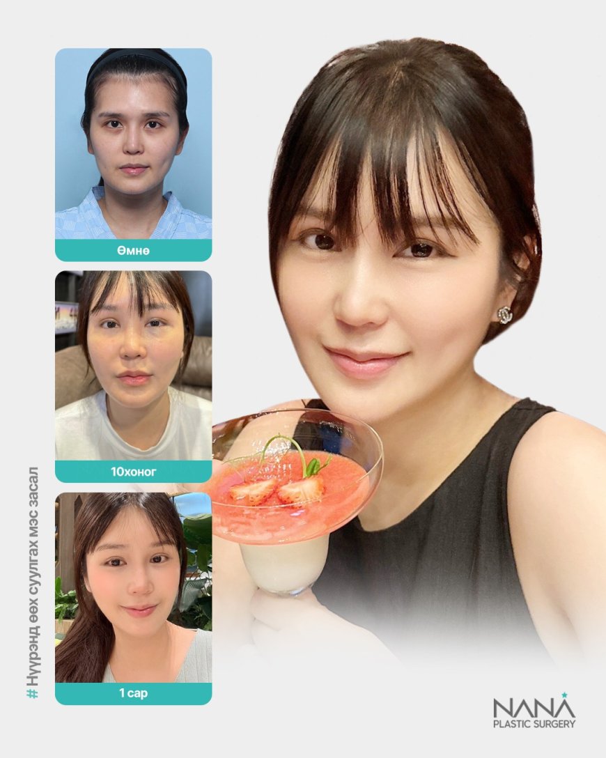 Нүүрэнд өөх суулгах мэс заслын эдгэрэх явц болон үр дүн