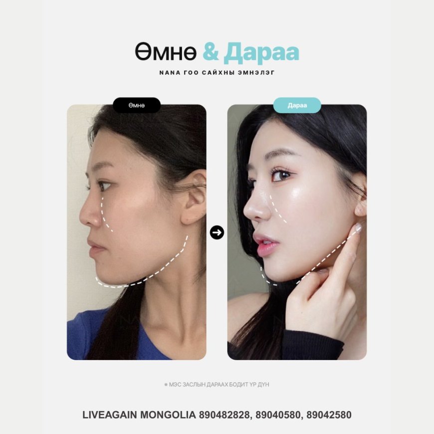 Нүүрний хэлбэр засах мэс заслын бодит үр дүн