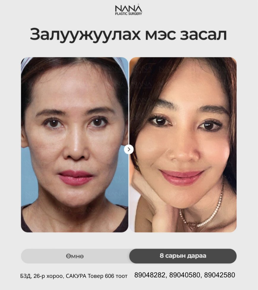 NANA Гоо сайхны эмнэлэгт “Залуужуулах мэс засал”-д орсон үйлчлүүлэгчийн өөрчлөлт