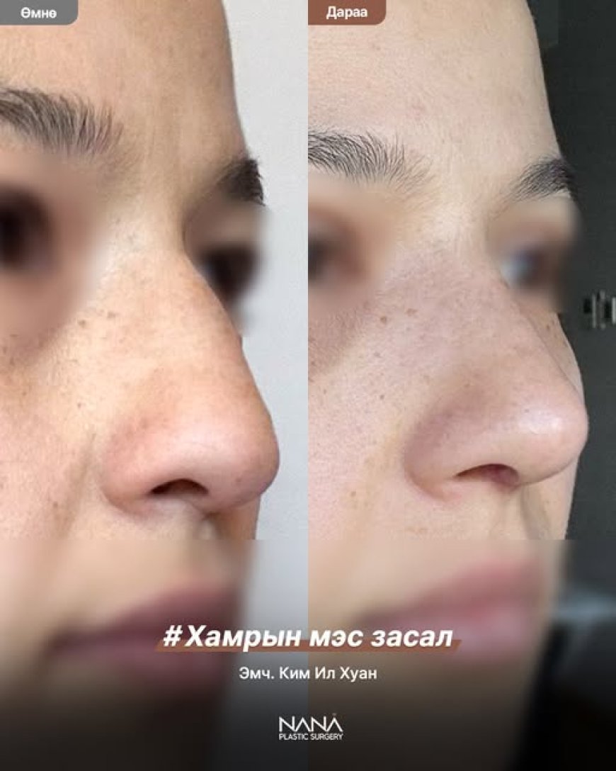 Хамрын мэс засал😍BEFORE & AFTER