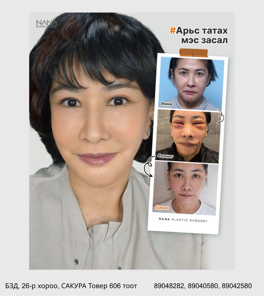 NANA залуужуулах мэс заслын 2 сарын дараах өөрчлөлт