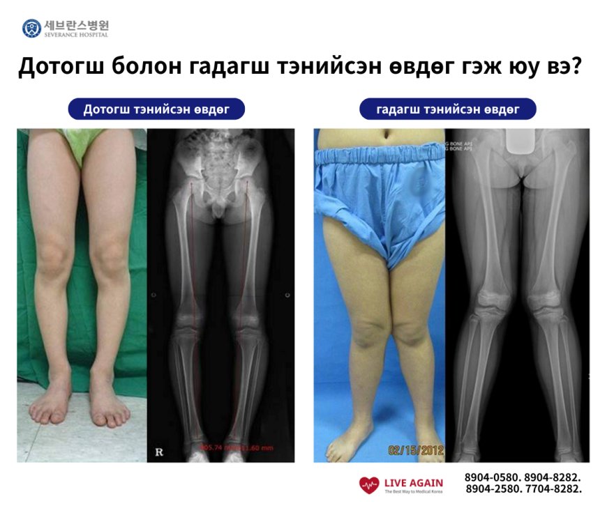 🧑‍⚕️Дотогш болон гадагш тэнийсэн өвдөг гэж юу вэ?