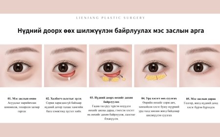 💎 3 Алхамт Нүдний Доорх Өөх Шилжүүлэн Байрлуулах Мэс Засал