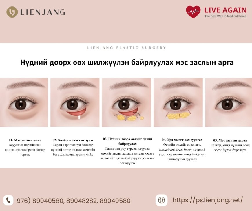 💎 3 Алхамт Нүдний Доорх Өөх Шилжүүлэн Байрлуулах Мэс Засал